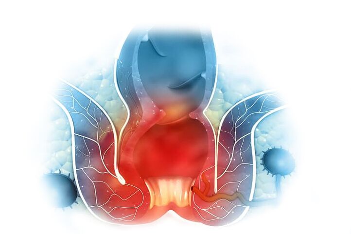 Tratamento eficaz de hemorróidas internas e externas com creme Proctonic